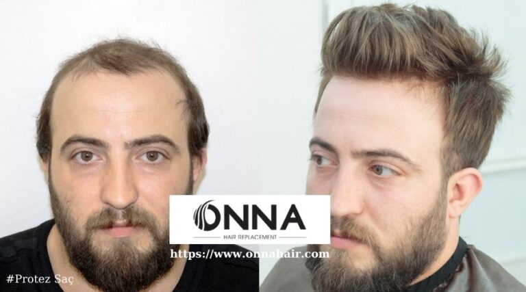 Protez Saç Kullananların Saç Stili İçin Moda Trendleri